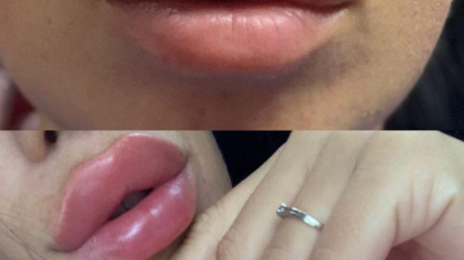 Detalii noi privind femeia din Moldova care pretindea ca e medic si facea proceduri de chirurgie estetica fara drept in Bucuresti: a mutilat zeci de femei