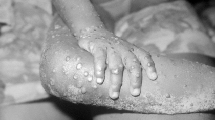 O boala rara extrem de infectioasa a provocat alerta in SUA. Ce este „variola maimutei” - FOTO