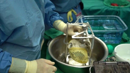 Prima femeie din Statele Unite care primeste o inima artificiala Prima femeie din Statele Unite care primeste o inima artificiala