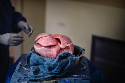 Premiera in lumea medicala. Cum a salvat o drona viata unui pacient care astepta un transplant de plamani - VIDEO Premiera in lumea medicala. Cum a salvat o drona viata unui pacient care astepta un transplant de plamani - VIDEO