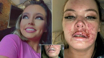 O americanca a fost aproape sa isi piarda buza superioara dupa o injectie cu botox
O americanca a fost aproape sa isi piarda buza superioara dupa o injectie cu botox