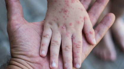 SUA confirma primele doua cazuri de variola maimutei la copii