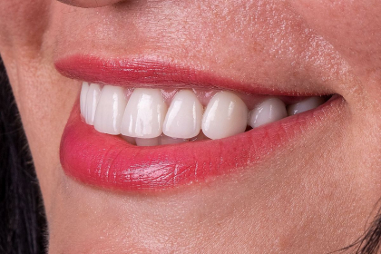 Iti doresti sa ai un zambet ca la Hollywood? Fatetele dentare sunt optiunea perfecta pentru tine. Afla totul despre acestea de la Clinica stomatologica Doctor Romaniuc