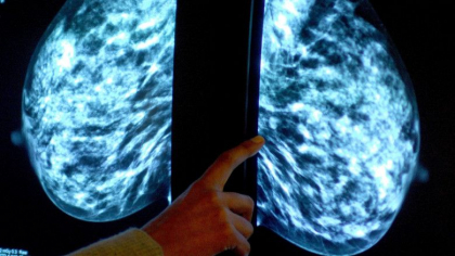 Europa se va confrunta cu o "epidemie de cancer", avertizeaza oncologii. Un milion de cazuri ar fi ramas nediagnosticate in pandemie