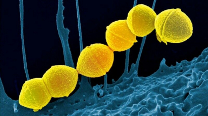Alerta in Marea Britanie. Sase copii au murit din cauza infectiei cu streptococul A, care provoaca scarlatina Alerta in Marea Britanie. Sase copii au murit din cauza infectiei cu streptococul A, care provoaca scarlatina