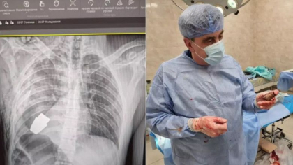 Un soldat ucrainean care avea in el o grenada neexplodata a fost operat cu succes de medicii militari