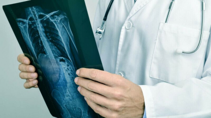 Povestea barbatului care are cinci rinichi. A supravietuit si unei forme rare de cancer Povestea barbatului care are cinci rinichi. A supravietuit si unei forme rare de cancer