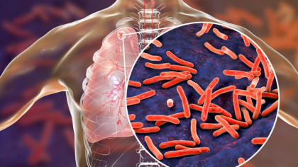 Avertismentul expertilor: Numarul deceselor cauzate de tuberculoza in Europa este in crestere Avertismentul expertilor: Numarul deceselor cauzate de tuberculoza in Europa este in crestere