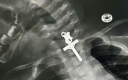 „Este un miracol”. Cum au reusit medicii sa salveze o fetita de zece luni, care a inghitit un crucifix. I s-a blocat in gat - VIDEO „Este un miracol”. Cum au reusit medicii sa salveze o fetita de zece luni, care a inghitit un crucifix. I s-a blocat in gat - VIDEO