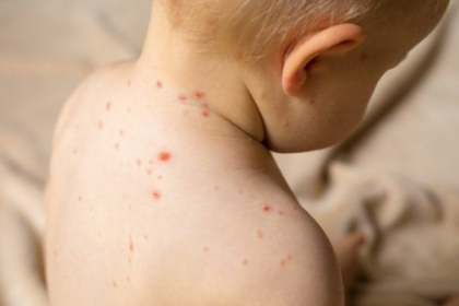 Inca un copil din Moldova - diagnosticat cu rujeola. Precizarile ANSP