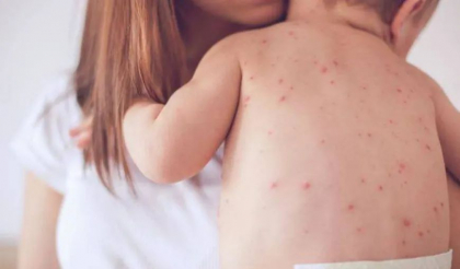 Cresc cazurile de rujeola. Cum putem preveni infectarea Cresc cazurile de rujeola. Cum putem preveni infectarea