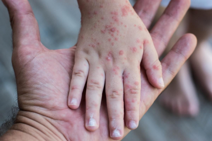 Un nou focar de rujeolă, confirmat, în Chișinău: O familie cu cinci copii a ajuns în atenția medicilor Un nou focar de rujeolă, confirmat, în Chișinău: O familie cu cinci copii a ajuns în atenția medicilor
