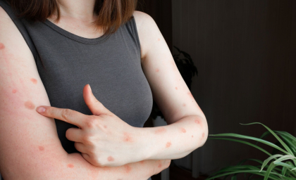 Apar noi cazuri de infecţie cu varianta mai periculoasă de mpox. Țările care au confirmat îmbolnăviri Apar noi cazuri de infecţie cu varianta mai periculoasă de mpox. Țările care au confirmat îmbolnăviri