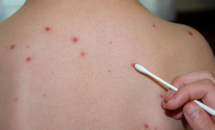 Trei cazuri suspecte de rujeolă în capitală. Responsabilii: „Niciunul dintre copiii afectați nu au fost vaccinați ”