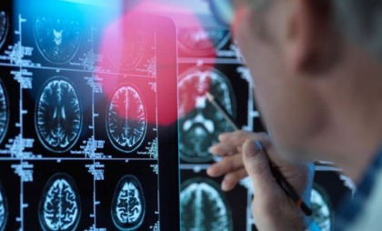 Un medicament pentru tratarea bolii Alzheimer în stadii timpurii este aproape de autorizare în UE. Ce este donanemab
Un medicament pentru tratarea bolii Alzheimer în stadii timpurii este aproape de autorizare în UE. Ce este donanemab