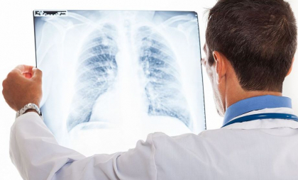 Un nou tratament pentru cancerul pulmonar a fost aprobat în SUA. Cum ar putea contribui la stoparea simptomelor bolii
Un nou tratament pentru cancerul pulmonar a fost aprobat în SUA. Cum ar putea contribui la stoparea simptomelor bolii