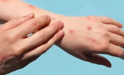 Infecție cu virusul variolei maimuței Infecție cu virusul variolei maimuței