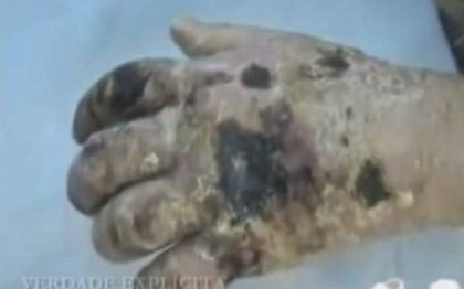 Drogul Krokodil ar fi "lovit" Statele Unite. Arizona este statul de unde s-ar putea raspandi Drogul Krokodil ar fi "lovit" Statele Unite. Arizona este statul de unde s-ar putea raspandi