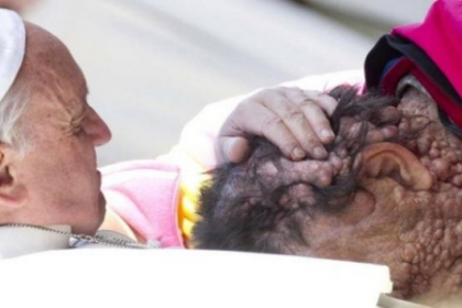 Imaginea care a emotionat credinciosii. Papa a alinat un alt barbat desfigurat