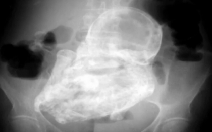 Doctorii au gasit un fetus de 40 de ani pietrificat in pantecele unei femei de 82 de ani. VIDEO