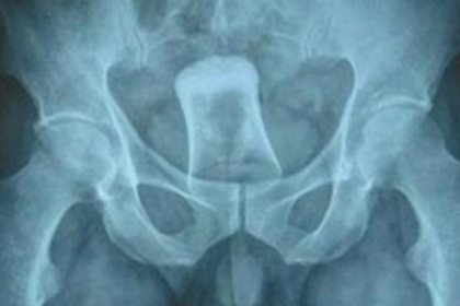 Ce au descoperit medicii chinezi despre un barbat dupa ce i-au facut o radiografie. FOTO Ce au descoperit medicii chinezi despre un barbat dupa ce i-au facut o radiografie. FOTO