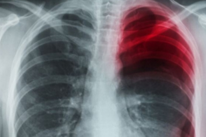 Un chinez a cascat atat de tare incat si-a perforat un plaman. Explicatia medicilor Un chinez a cascat atat de tare incat si-a perforat un plaman. Explicatia medicilor