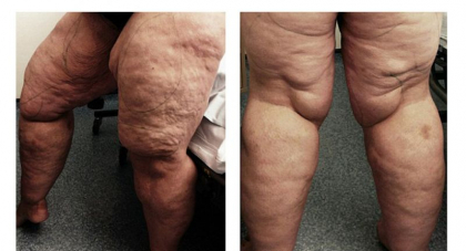 Avea picioarele asa si a vrut sa-si faca liposuctie! Medicii i-au extras 12 litri de grasime! Vezi cum arata acum - FOTO