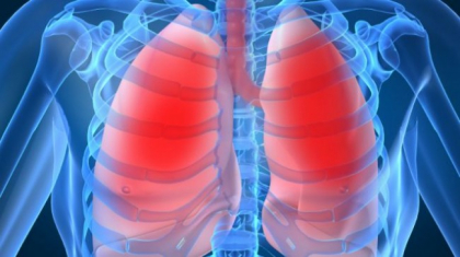 Alimentul care ucide 85% din celulele cancerului pulmonar! Ce au descoperit specialistii Alimentul care ucide 85% din celulele cancerului pulmonar! Ce au descoperit specialistii