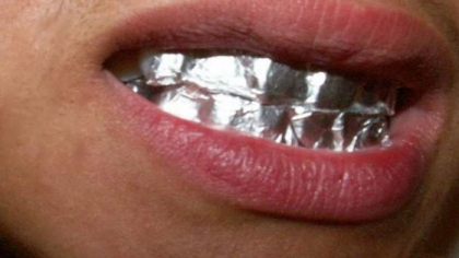 Si-a pus folie de aluminiu pe dinti si a stat asa timp de o ora in fiecare zi. Rezultatul este spectaculos