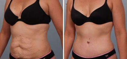 Cum sa scapi de vergeturi si de grasimea abdominala printr-o metoda foarte simpla Cum sa scapi de vergeturi si de grasimea abdominala printr-o metoda foarte simpla