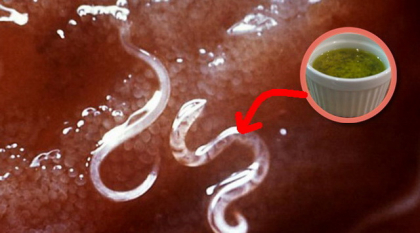 Acest mujdei de usturoi distruge parazitii intestinali! Vezi cum sa-l prepari Acest mujdei de usturoi distruge parazitii intestinali! Vezi cum sa-l prepari