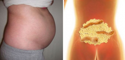 Aceasta bacterie provoaca balonare si impiedica scaderea in greutate! Ce este de facut Aceasta bacterie provoaca balonare si impiedica scaderea in greutate! Ce este de facut