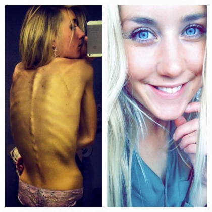 A fost la un pas de moarte din cauza anorexiei, dar acum e o femeie sexy! Vezi cum s-a transformat - FOTO A fost la un pas de moarte din cauza anorexiei, dar acum e o femeie sexy! Vezi cum s-a transformat - FOTO