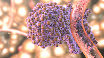 Alimentul care raspandeste cancerul in tot corpul. Renunta la el cat mai rapid Alimentul care raspandeste cancerul in tot corpul. Renunta la el cat mai rapid
