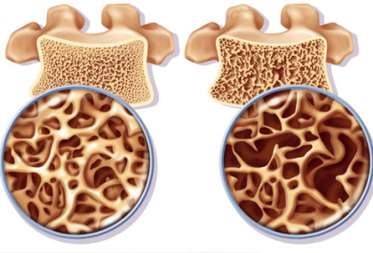 Alimente si bauturi care "fura" calciul din organism si favorizeaza aparitia osteoporozei