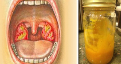A baut acest amestec alcatuit din trei ingrediente si a scapat de tuse instantaneu A baut acest amestec alcatuit din trei ingrediente si a scapat de tuse instantaneu