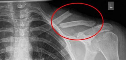 Otrava care iti distruge oasele, insa o bei in fiecare zi! Sigur nu stiai asta