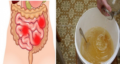 Acest remediu din 2 ingrediente elimina kilograme de materii reziduale din colon Acest remediu din 2 ingrediente elimina kilograme de materii reziduale din colon