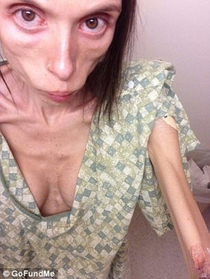 Aceasta fata suferea de anorexie si a povestit crunta ei lupta. Uite cum arata acum - FOTO Aceasta fata suferea de anorexie si a povestit crunta ei lupta. Uite cum arata acum - FOTO