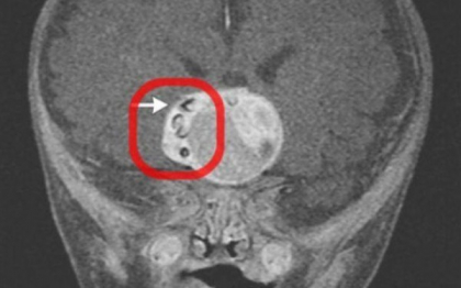 Cazul unic in lume care a luat prin surprindere lumea medicala. Ce s-a descoperit in tumoarea de pe creierul unui copil Cazul unic in lume care a luat prin surprindere lumea medicala. Ce s-a descoperit in tumoarea de pe creierul unui copil