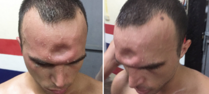 Un luptator de Muay Thai s-a ales cu o gaura in craniu! Cum arata dupa operatie