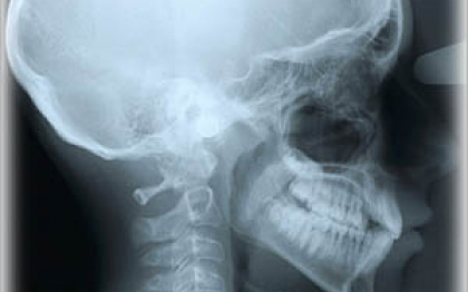 Suferea de dureri grave de cap de zece ani. Ce au descoperit doctorii dupa ce i-au facut o radiografie