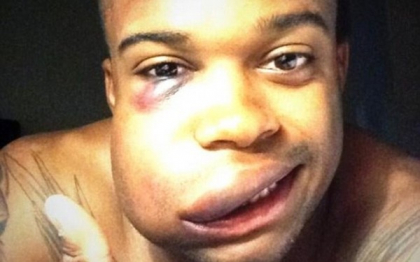 Cum arata un jucator de baseball dupa ce este lovit in fata de o minge cu viteza de 145 de kilometri la ora. FOTO