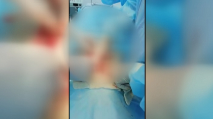 Caz iesit din comun in Kazahstan. Un ghem de par incalcit de trei kilograme si jumatate, a fost scos de catre medici din stomacul unei fetite de 12 ani - VIDEO Caz iesit din comun in Kazahstan. Un ghem de par incalcit de trei kilograme si jumatate, a fost scos de catre medici din stomacul unei fetite de 12 ani - VIDEO