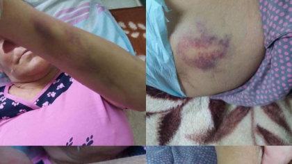 Concluziile celor de la Sanatate in cazul celor doi pacienti care ar fi fost tratati in conditii inumane la Spitalul de Psihiatrie din Orhei: la internare, una avea 45 de kg si mai multe vanatai, iar altul a avut un conflict cu alte pacienti