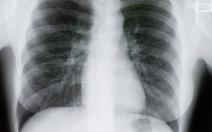 A supravietuit unui accident de motocicleta, insa medicii nu i-au mai gasit inima la locul ei. Cazul sau este unic A supravietuit unui accident de motocicleta, insa medicii nu i-au mai gasit inima la locul ei. Cazul sau este unic