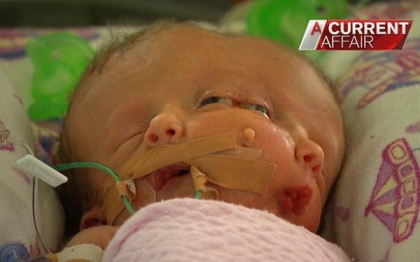 Miracol in Australia. Siamezele cu doua creiere in acelasi craniu au supravietuit nasterii si au invins sansele potrivnice Miracol in Australia. Siamezele cu doua creiere in acelasi craniu au supravietuit nasterii si au invins sansele potrivnice