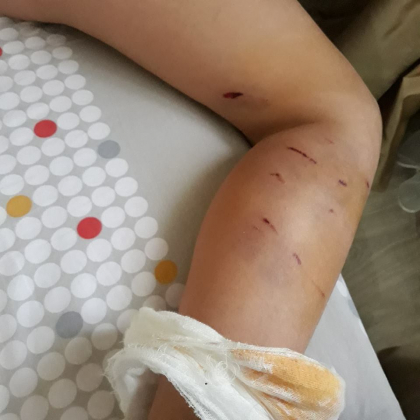 O femeie din Drochia sustine ca fiul ei de 7 ani a fost atacat de mai multi caini, pe teritoriul scolii in timp ce se intorcea acasa. Politia s-a autosesizat dupa o postare de pe facebook - FOTO