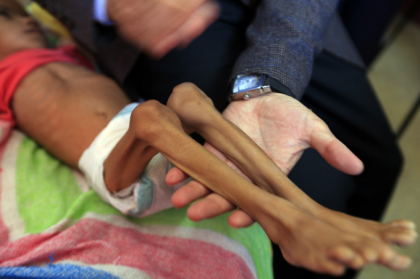 Fetita devenita simbol pentru razboiul din Yemen a murit. "Inima mi-e franta" Fetita devenita simbol pentru razboiul din Yemen a murit. "Inima mi-e franta"