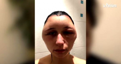 O tanara din Franta a fost desfigurata de un produs banal. Aproape toate femeile il folosesc - VIDEO O tanara din Franta a fost desfigurata de un produs banal. Aproape toate femeile il folosesc - VIDEO